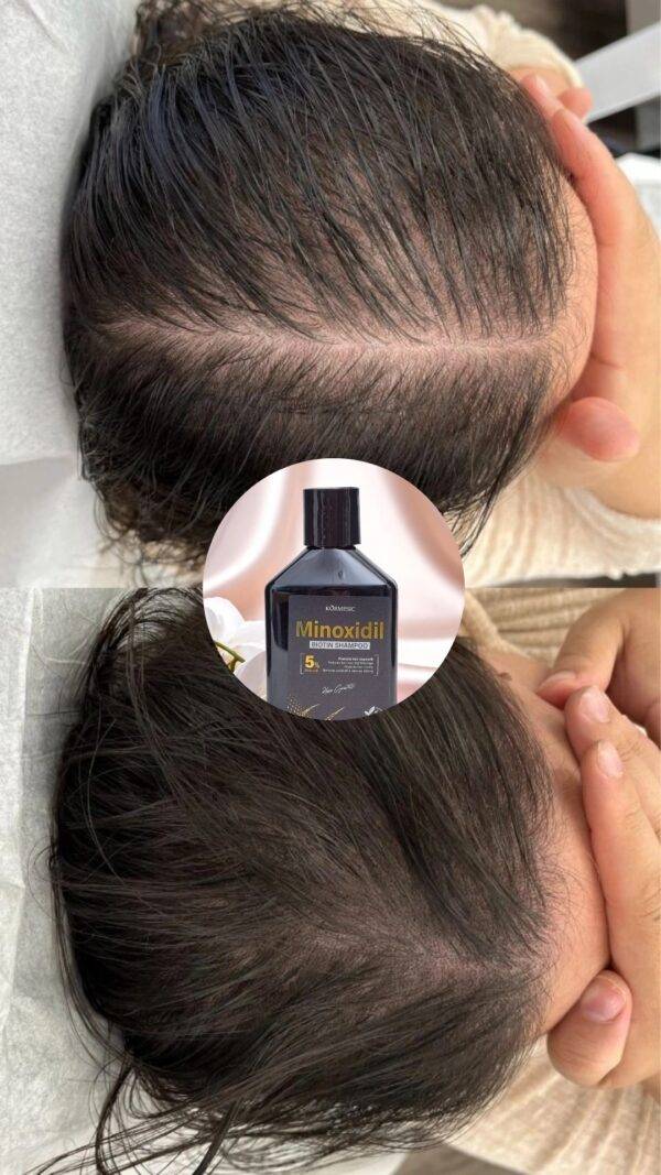KMC64578 - SHAMPOO MINOXIDIL X "KORMESIC" (1 PZA)